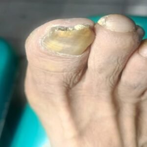 onicomicosis